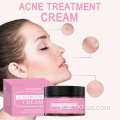 crema per brufoli per uomo crema per l&#39;acne